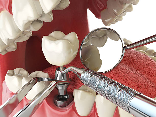 Best Lost Filling or Crown Replacement in Crandon, WI